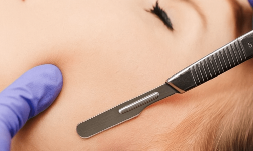O dermaplaning remove as células mortas e os pelinhos do rosto, deixando a pele mais lisa e radiante.